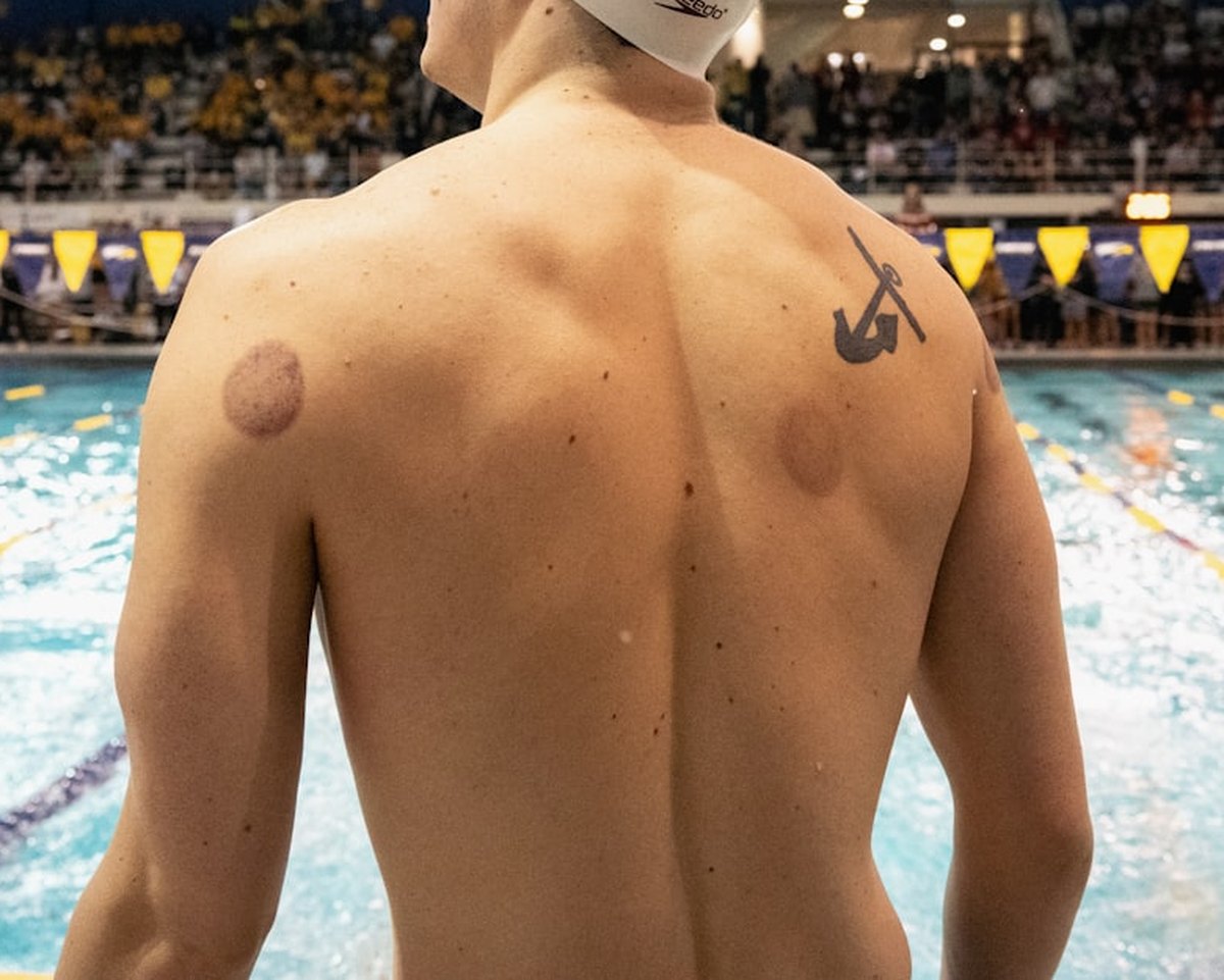 A swimmer's bare back showing round marks left by cupping several days earlier.